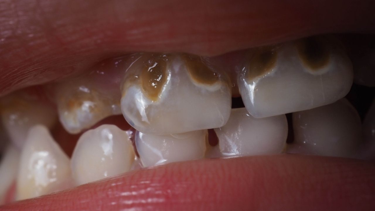 Diş Çürüğü Tedavisi Nasıl Yapılır